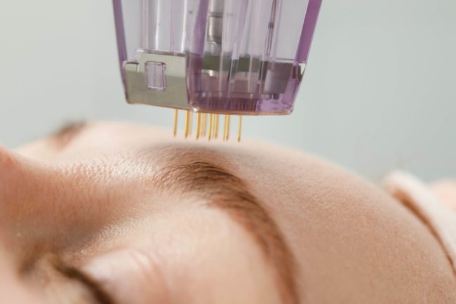 What Is The Optimal Care For Skin After Microneedling