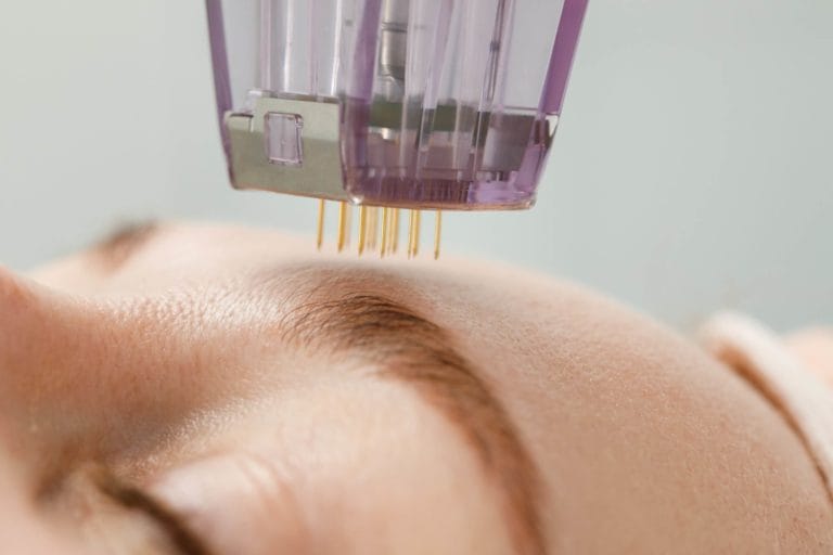 What Is The Optimal Care For Skin After Microneedling