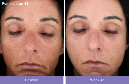 Vitalize Peel® & LYTERA® Skin Brighten Treatmenti in VERNAL ,UT by Refresh Aestheticsng