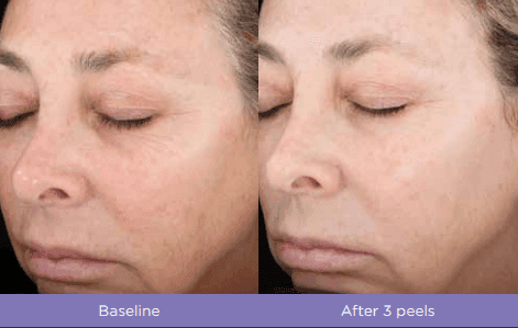 Chemical Peels 4 Chemical Peels Fitzpatrick skin type: III Treatment in VERNAL ,UT by Refresh Aesthetics