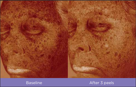 VITALIZE PEEL® Fitzpatrick skin type: III Treatment in VERNAL ,UT by Refresh Aesthetics